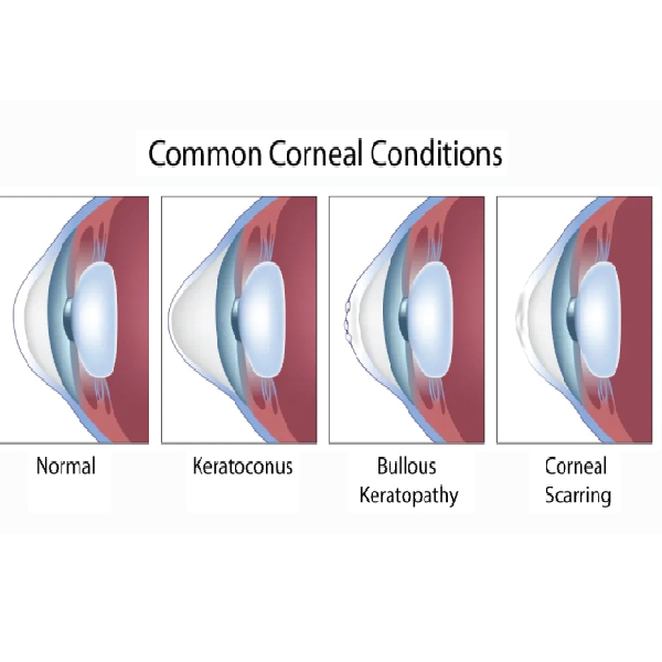 Noor Malabar Eye Hospital+Cornea