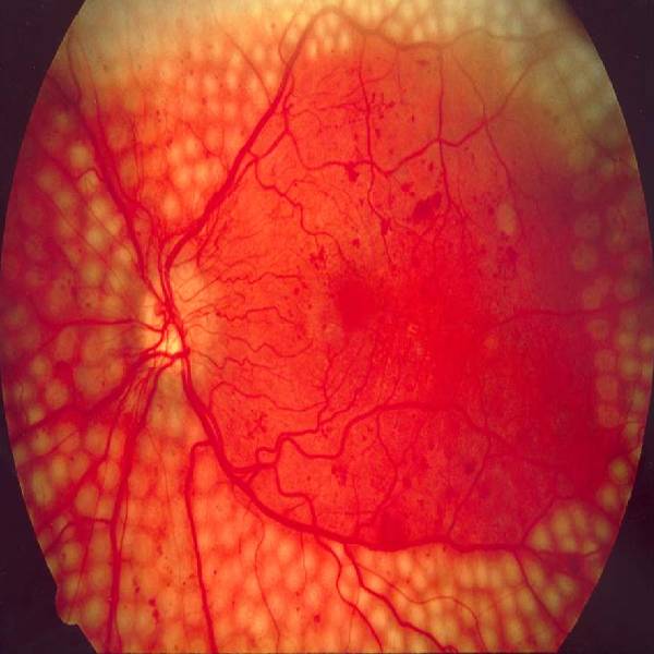 Eye Soul+Diabetic Retinopathy